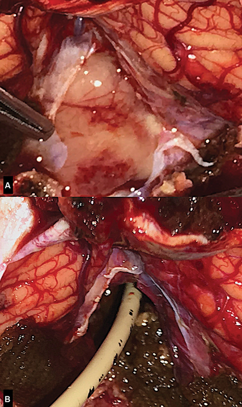 Adult Brainstem Astroblastoma: Unusual Presentation of a Rare Tumor.