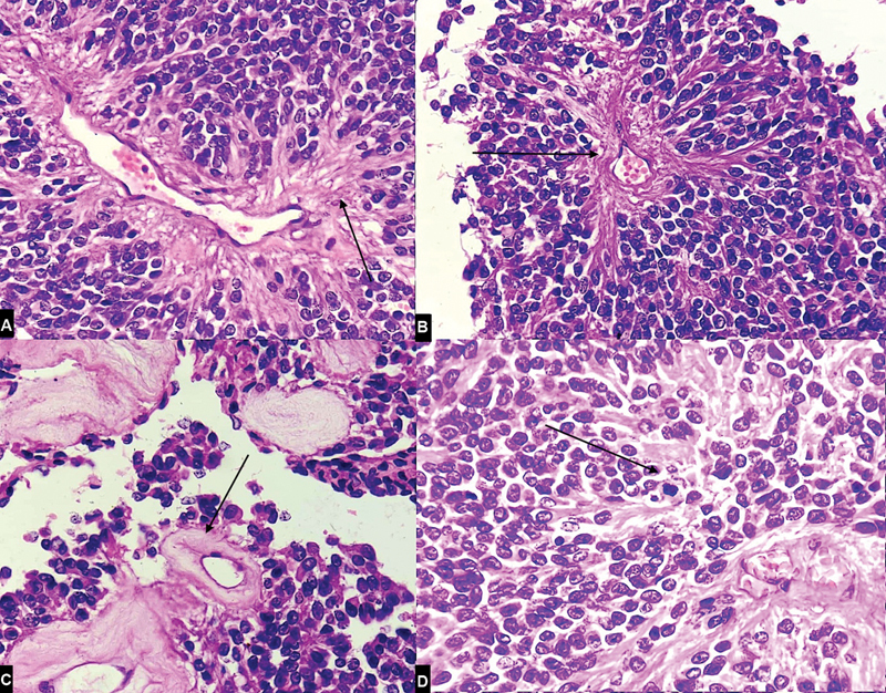 Adult Brainstem Astroblastoma: Unusual Presentation of a Rare Tumor.