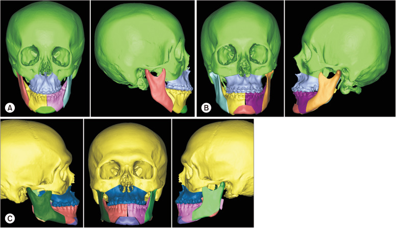 Mandibular midline osteotomy for correction of bimaxillary transverse discrepancy: a technical note.