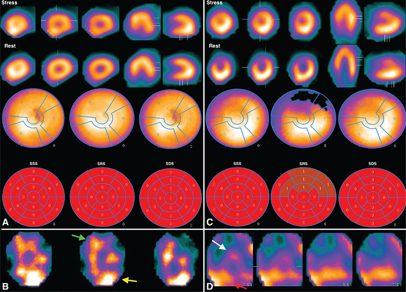 Potential Role of Somatostatin Receptor Scintigraphy for <i>In Vivo</i> Imaging of Vulnerable Atherosclerotic Plaques and Its Association with Myocardial Perfusion Imaging Finding: A Preliminary Study.