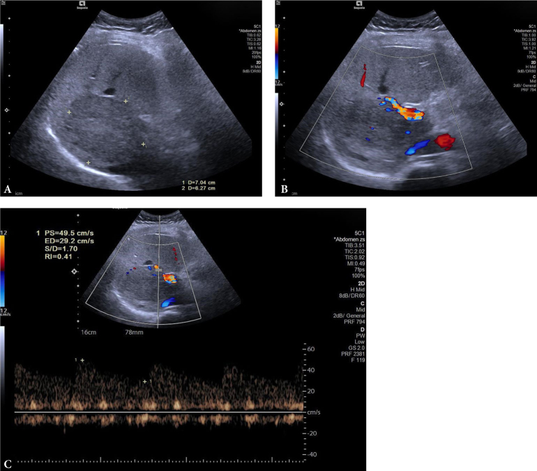 The diagnostic value of Doppler Resistive Index in the differential diagnosis of focal liver lesions.