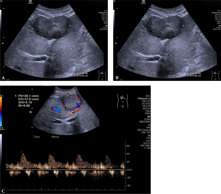 The diagnostic value of Doppler Resistive Index in the differential diagnosis of focal liver lesions.