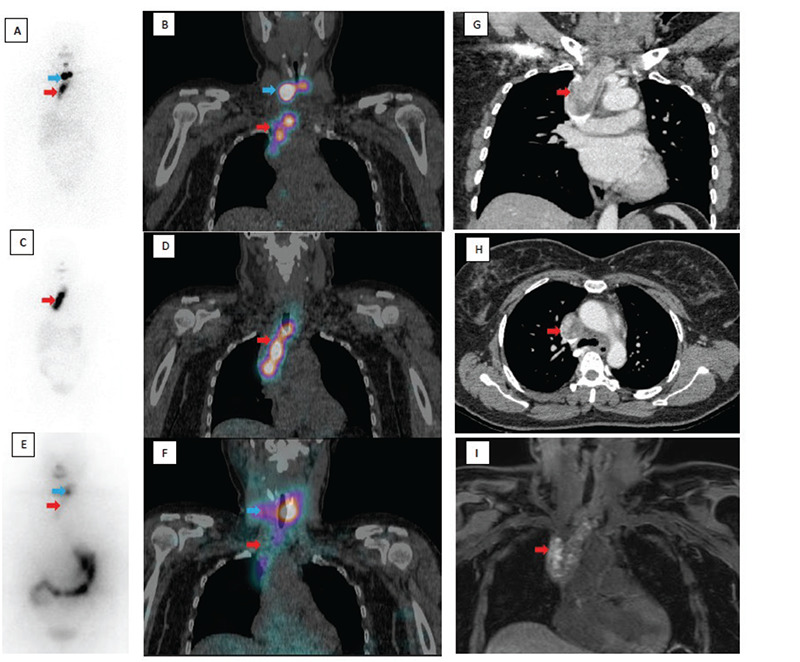 I-131 Avid Tumor Thrombus in a Case of Poorly Differentiated Thyroid Cancer.