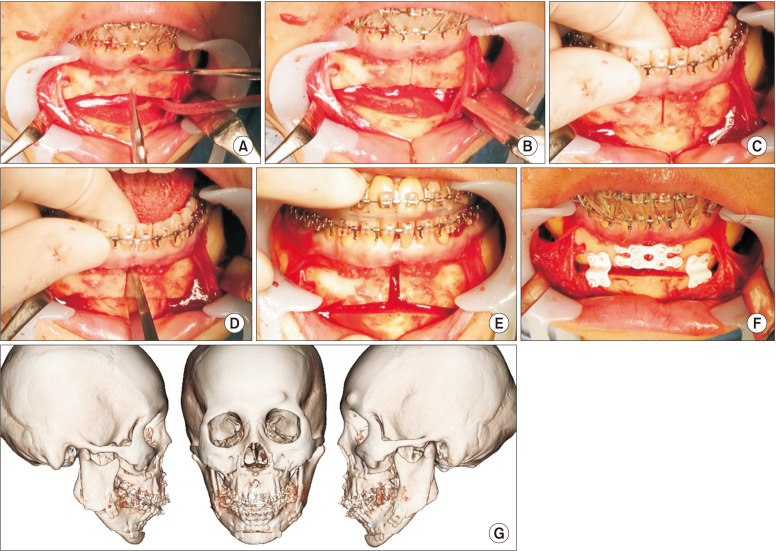 Mandibular midline osteotomy for correction of bimaxillary transverse discrepancy: a technical note.