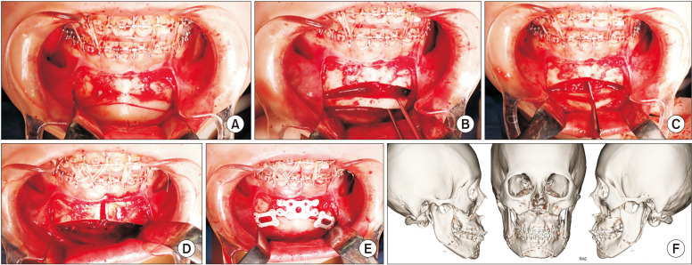 Mandibular midline osteotomy for correction of bimaxillary transverse discrepancy: a technical note.