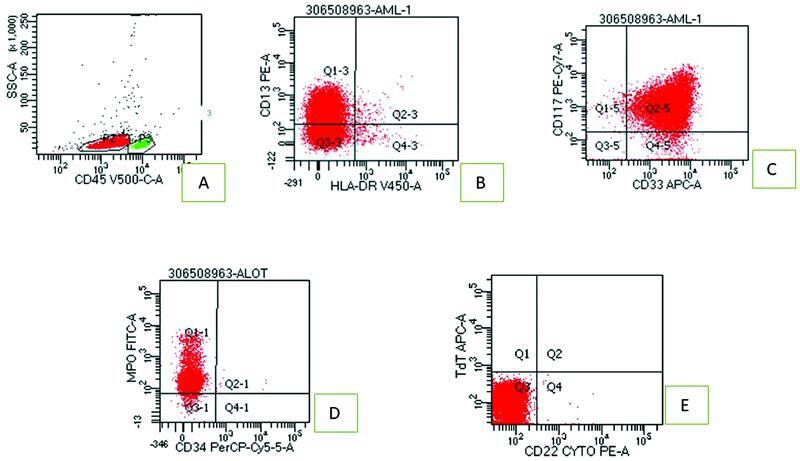 Twin Malignancy of Acute Myeloid Leukemia and Multiple Myeloma in a Chemotherapy-Naïve Patient: A Rare Occurrence.