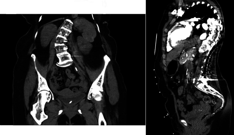 <i>FKBP14</i> kyphoscoliotic Ehlers-Danlos syndrome misdiagnosed as Larsen syndrome: a case report.