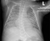 Case Report: Congenital tuberculosis in a premature infant requiring extracorporeal membrane oxygenation.