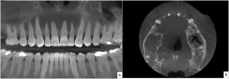 COVID-related mucormycosis mimicking dental infection