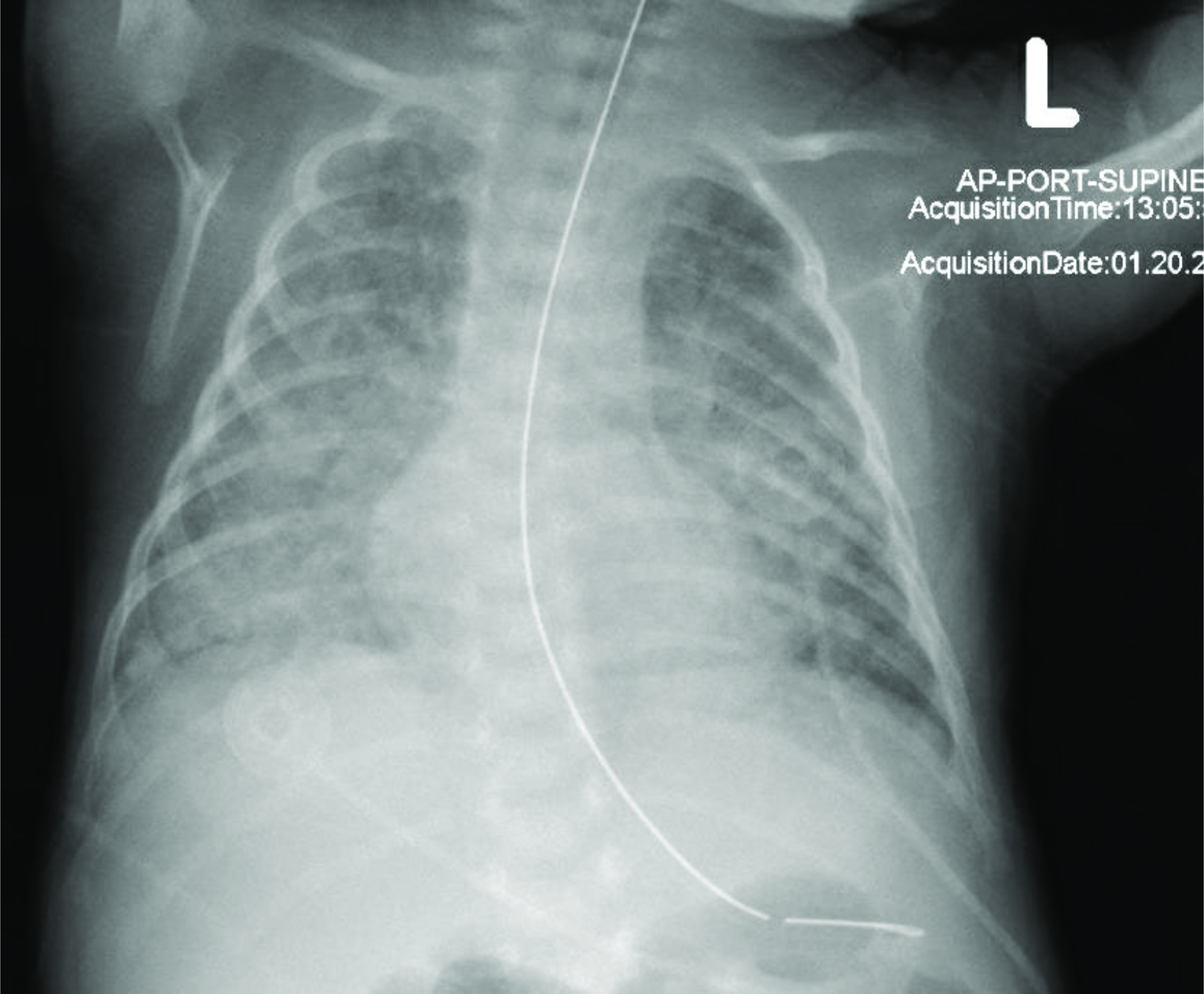 Case Report: Congenital tuberculosis in a premature infant requiring extracorporeal membrane oxygenation.