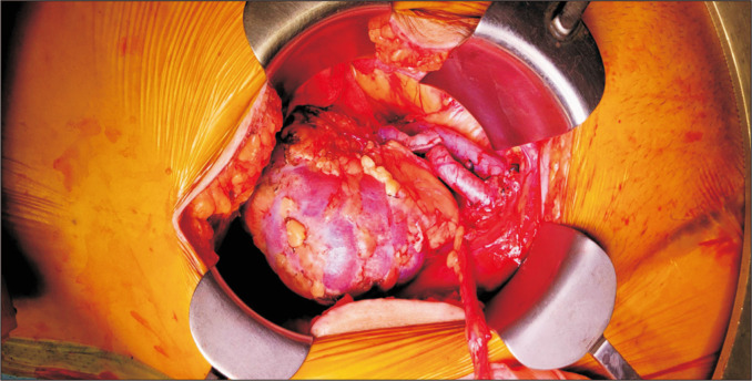 The first use of hypothermic machine perfusion in Korea to recover a procured kidney graft and prevent prolonged cold ischemic time: a case report.