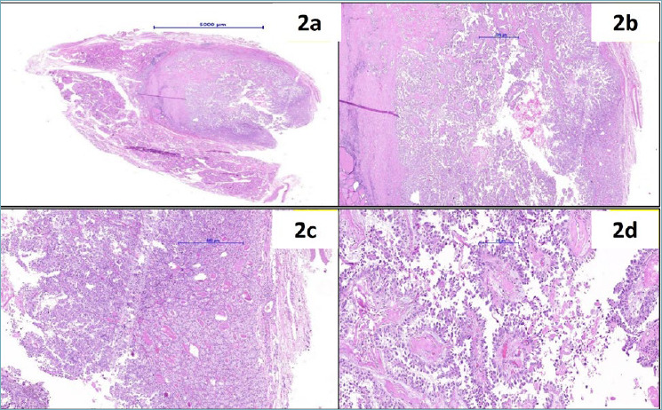 Intratumoural metastasis of primary lung adenocarcinoma to non-invasive follicular thyroid neoplasm with papillary-like nuclear features.