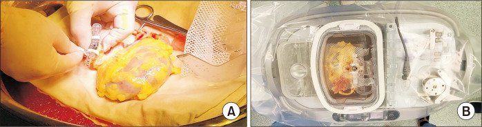 The first use of hypothermic machine perfusion in Korea to recover a procured kidney graft and prevent prolonged cold ischemic time: a case report.