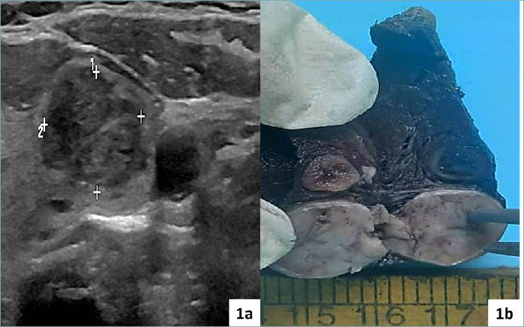 Intratumoural metastasis of primary lung adenocarcinoma to non-invasive follicular thyroid neoplasm with papillary-like nuclear features.