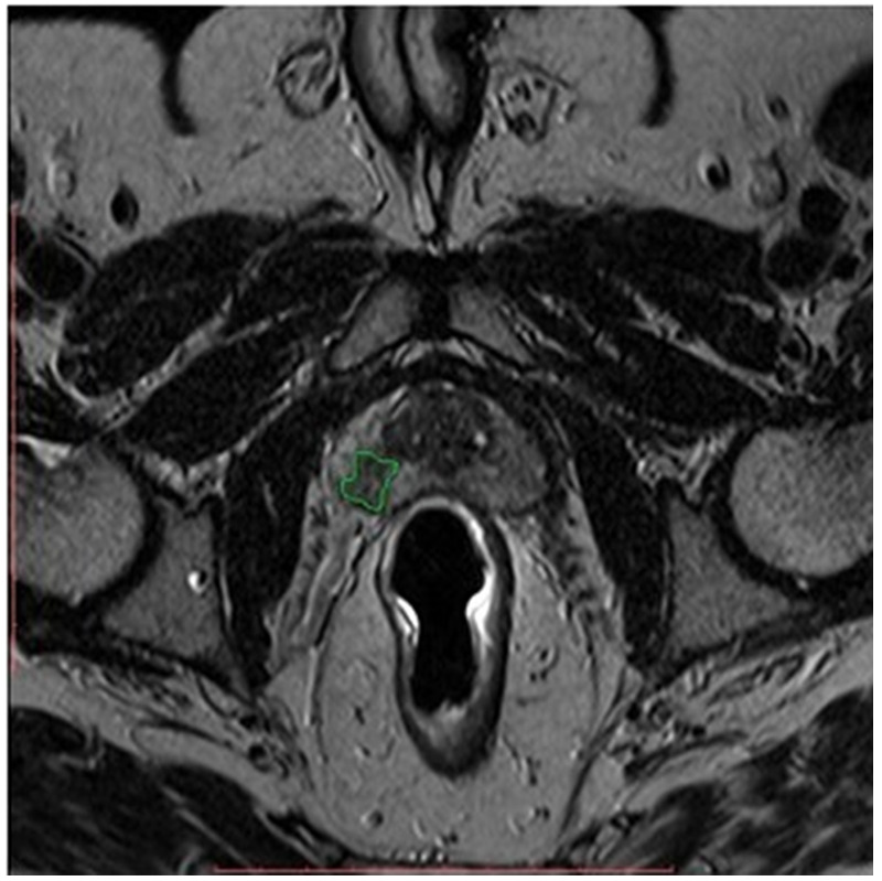 Quantification of Multi-Parametric Magnetic Resonance Imaging Based on Radiomics Analysis for Differentiation of Benign and Malignant Lesions of Prostate.