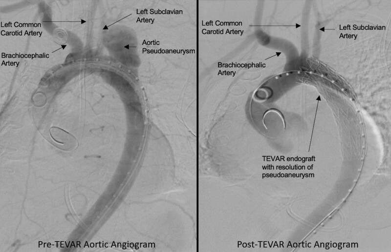 Thoracic Aortic Injuries Following Intra-Aortic Balloon Pump Placement: A Retrospective Case Series.