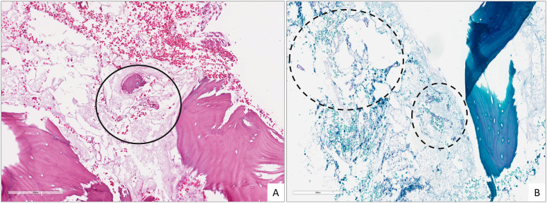 COVID-related mucormycosis mimicking dental infection