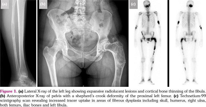 Shepherd's crook deformity: Do you recognize this sign?