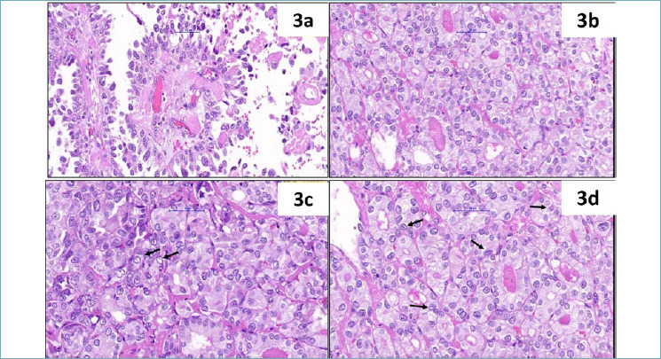 Intratumoural metastasis of primary lung adenocarcinoma to non-invasive follicular thyroid neoplasm with papillary-like nuclear features.