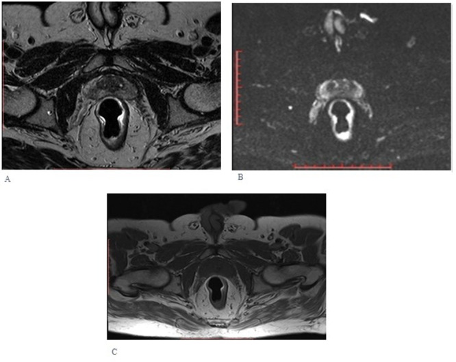 Quantification of Multi-Parametric Magnetic Resonance Imaging Based on Radiomics Analysis for Differentiation of Benign and Malignant Lesions of Prostate.