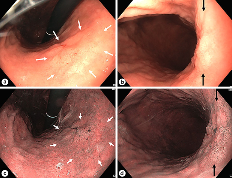 Advanced Imaging in Gastrointestinal Endoscopy: A Literature Review of the Current State of the Art.