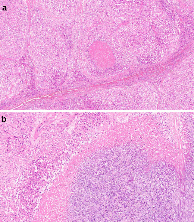 Prognostic Value of Microscopic Tumor Necrosis in Adrenal Cortical Carcinoma.