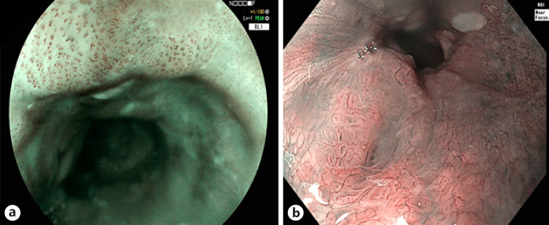 Advanced Imaging in Gastrointestinal Endoscopy: A Literature Review of the Current State of the Art.