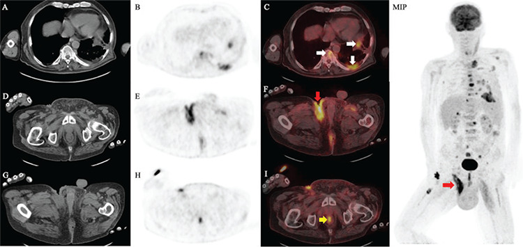 Cutaneous Metastase of Rectal Neuroendocrine Carcinoma Revealed on <sup>18</sup>F-FDG PET/CT.