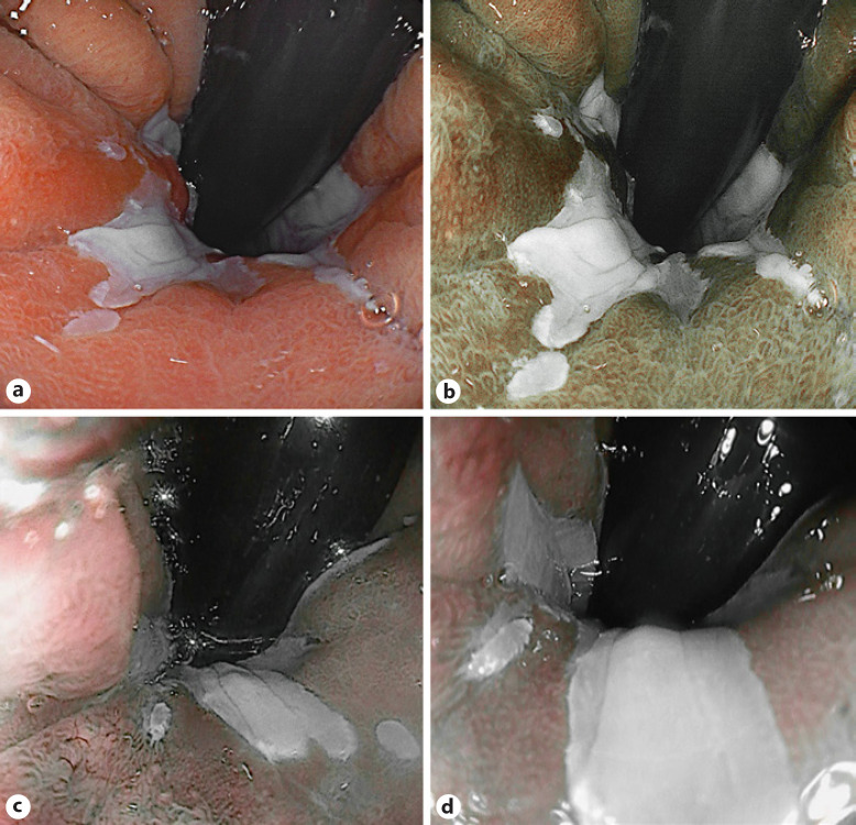 Advanced Imaging in Gastrointestinal Endoscopy: A Literature Review of the Current State of the Art.