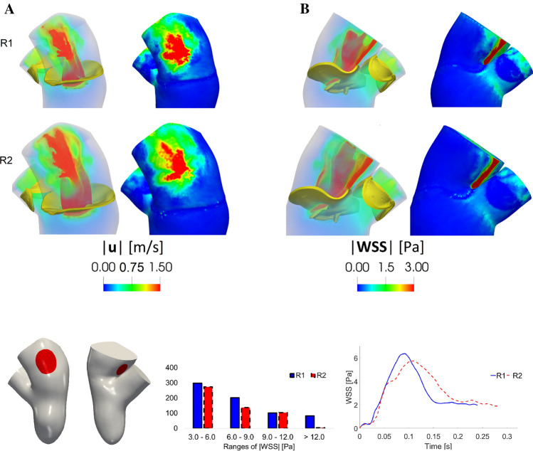 An Image-Based Computational Fluid Dynamics Study of Mitral Regurgitation in Presence of Prolapse.