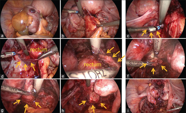 Postoperative Pregnancy Outcomes Following Laparoscopic Surgical Management in Women with Stage III/IV Endometriosis: A Single-Center Follow-Up Study.