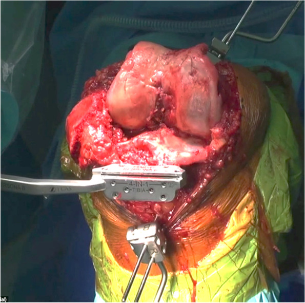 Incidence of soft tissue releases in robotic assisted cementless TKA with mechanical alignment and flexion gap balancing.