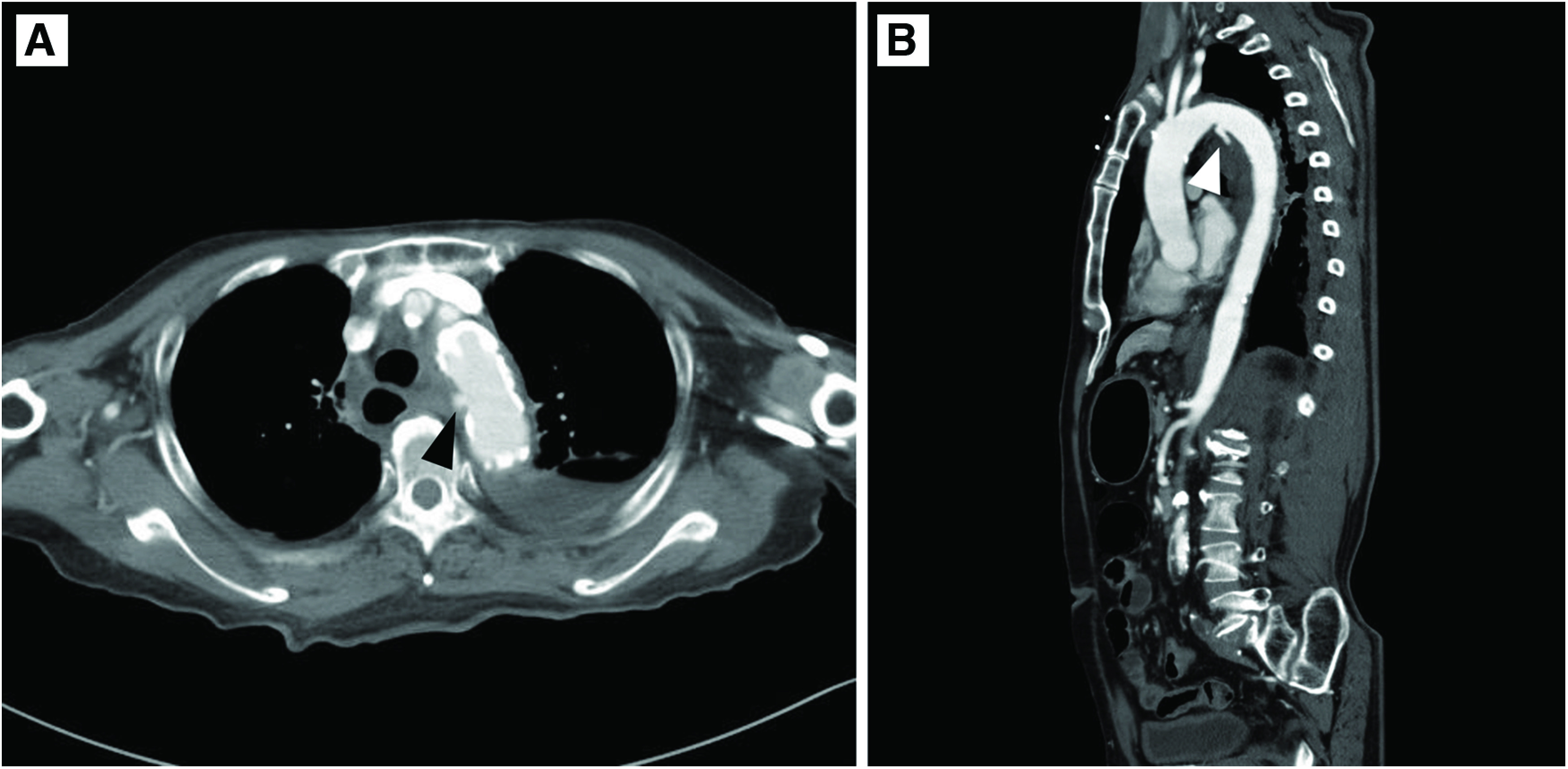 Effectiveness of Thoracic Endovascular Aortic Repair for Blunt Thoracic Aortic Injury.