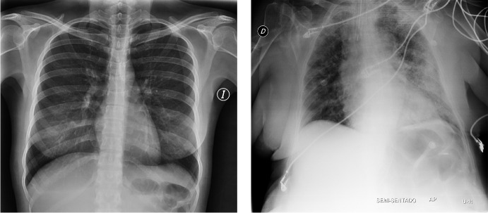 ResNetFed: Federated Deep Learning Architecture for Privacy-Preserving Pneumonia Detection from COVID-19 Chest Radiographs.