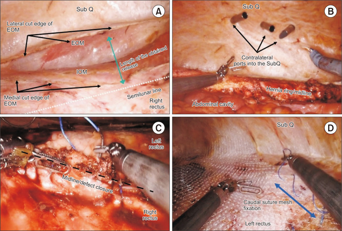 Robotic approach in complex ventral hernias: anterior component separation technique.