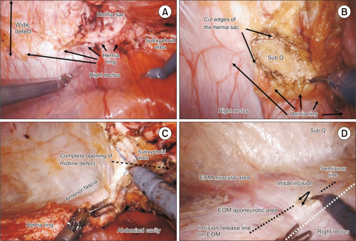 Robotic approach in complex ventral hernias: anterior component separation technique.