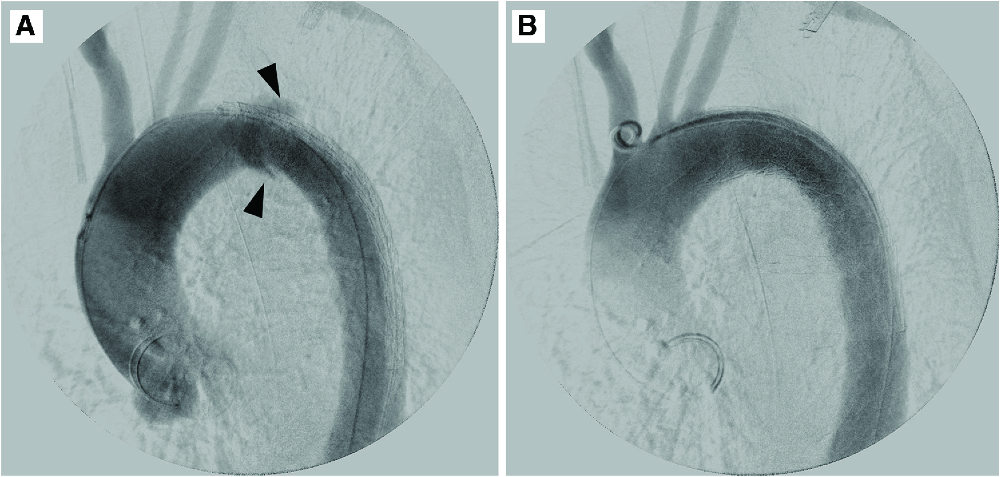 Effectiveness of Thoracic Endovascular Aortic Repair for Blunt Thoracic Aortic Injury.