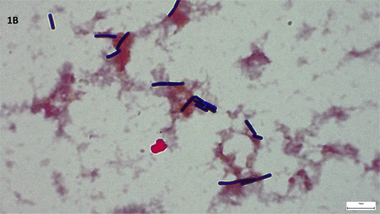 [Clostridium perfringens abscess in parenteral drug users].