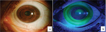 Comparison of Hybrid Contact Lenses and Rigid Gas-Permeable Contact Lenses in Moderate and Advanced Keratoconus.