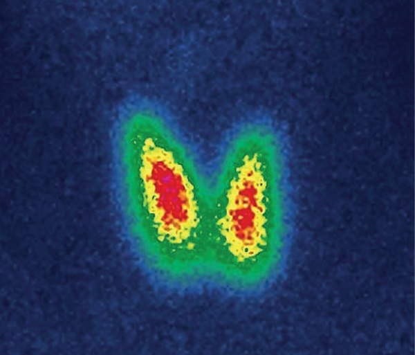 [Alemtuzumab-induced Graves' disease].