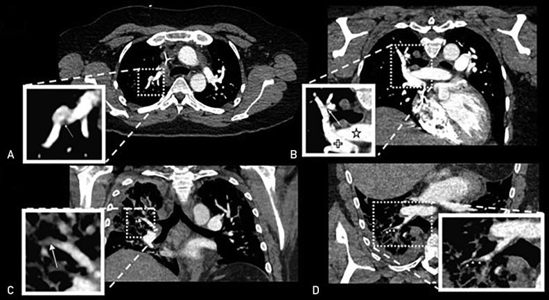 Evaluating the Performance of a Commercially Available Artificial Intelligence Algorithm for Automated Detection of Pulmonary Embolism on Contrast-Enhanced Computed Tomography and Computed Tomography Pulmonary Angiography in Patients With Coronavirus Disease 2019