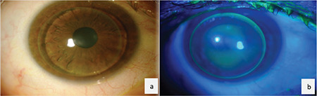 Comparison of Hybrid Contact Lenses and Rigid Gas-Permeable Contact Lenses in Moderate and Advanced Keratoconus.