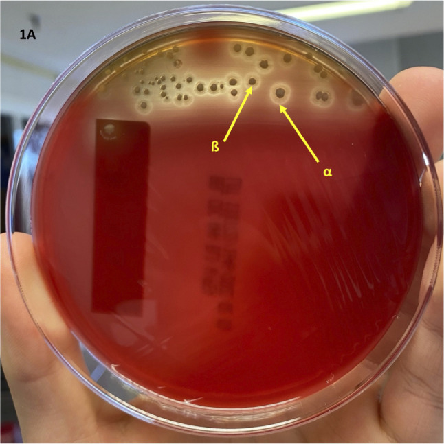 [Clostridium perfringens abscess in parenteral drug users].