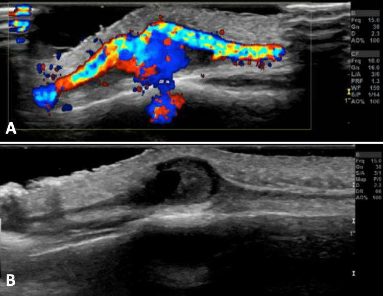 Enlarging traumatic superficial temporal artery pseudoaneurysm from a lacrosse ball injury: illustrative case.