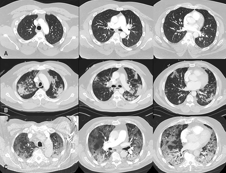 Evaluating the Performance of a Commercially Available Artificial Intelligence Algorithm for Automated Detection of Pulmonary Embolism on Contrast-Enhanced Computed Tomography and Computed Tomography Pulmonary Angiography in Patients With Coronavirus Disease 2019