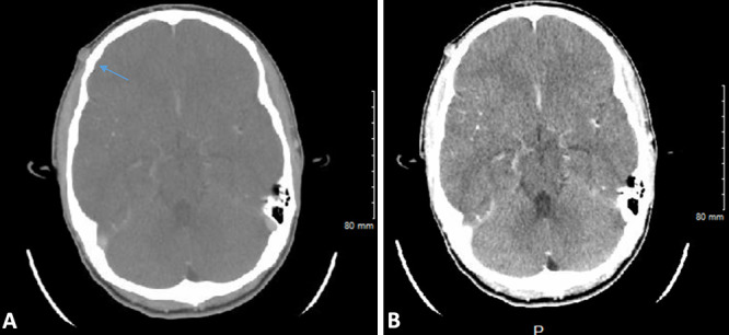 Enlarging traumatic superficial temporal artery pseudoaneurysm from a lacrosse ball injury: illustrative case.