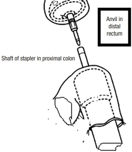 Outcomes of side-to-end versus end-to-end colorectal anastomosis in nonemergent sigmoid and rectal cancers: a randomized controlled clinical trial.