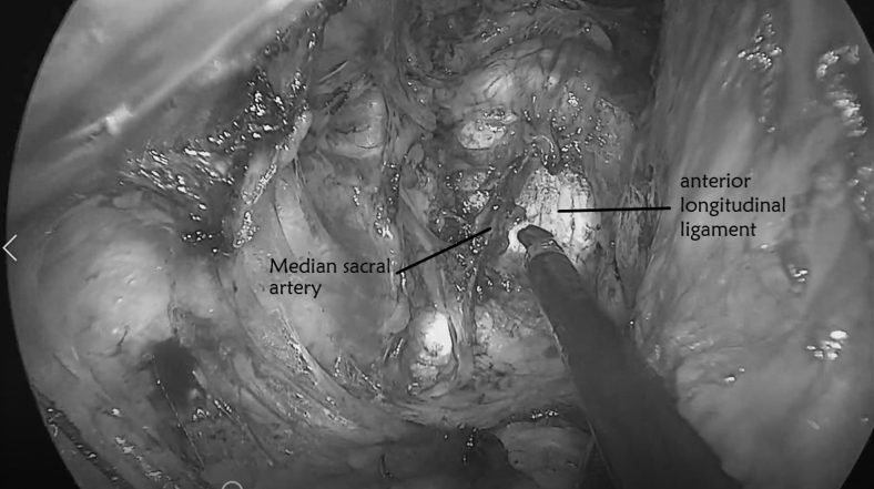 The Pure Extraperitoneal Approach for Sacrocolpopexy in Transvaginal Natural-Orifice Transluminal Endoscopic Surgery.