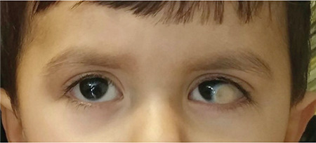 Lamellar Keratoplasty Using Microkeratome-Assisted Anterior Lamellar Graft in the Management of Deep Limbal Dermoid: A Case Report.