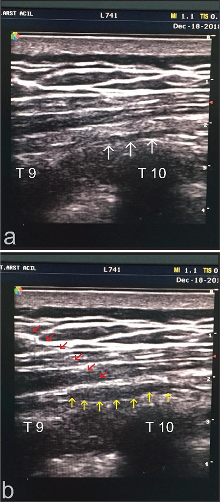 The Efficacy of Erector Spinae Plane Block for Patients Undergoing Percutaneous Nephrolithotomy.